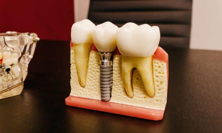 A detailed dental implant model showing the implant structure within the gum and bone, placed on a dark table in a dental office setting. This visual aids in explaining the components and benefits of dental implants.