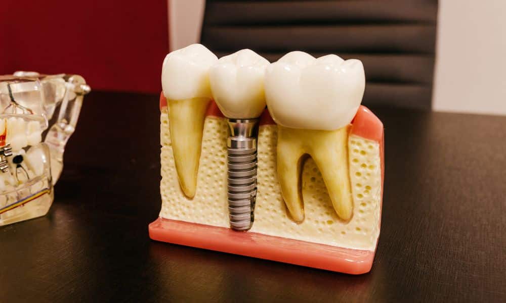 A detailed dental implant model showing the implant structure within the gum and bone, placed on a dark table in a dental office setting. This visual aids in explaining the components and benefits of dental implants.