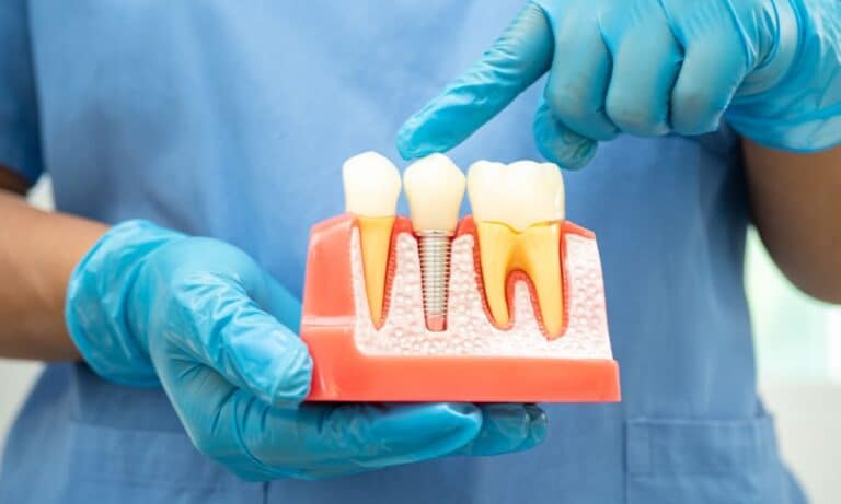 A dental professional holding a model of All-on-4 dental implants, demonstrating how they work as a tooth replacement option.