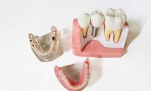 A detailed model showcasing a dental implant procedure alongside jaw models, illustrating how the dental implant procedure works.