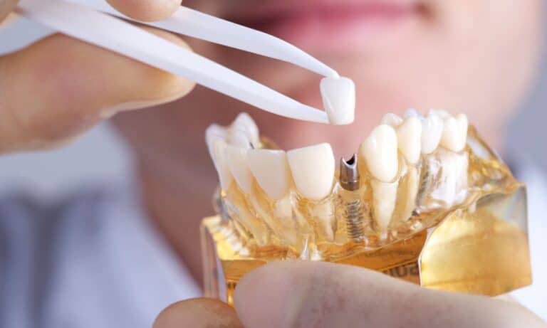 A close-up of a dentist's hands using tweezers to place a dental crown on an All-on-4 dental implant model. The background is slightly blurred, focusing on the precision of the dental procedure. The image illustrates the process involved in All-on-4 dental implants.