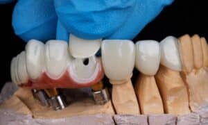 A close-up of a dental model with blue-gloved hands fitting a dental crown onto a set of dental implants, illustrating the process of placing dental crowns.
