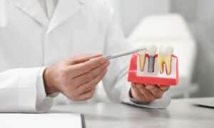 Dentist explaining the structure of dental implants using a detailed model. The dentist is wearing a white coat and holding a pen to point at the different parts of the implant. The background is a clean, professional dental office.