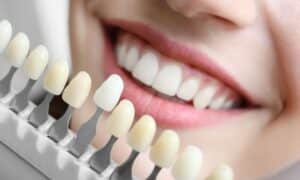 Close-up of a smiling woman comparing different shades of teeth whitening samples, highlighting the results and benefits of teeth whitening treatments.