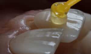 Close-up of a dental veneer being applied to a tooth, illustrating the precision and appeal of dental veneers as a popular choice for enhancing smiles.