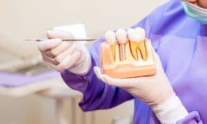 Dentist holding a model of dental implants, using a dental tool to explain the procedure. The model shows the structure of teeth and the implant process. The dentist is wearing gloves, a mask, and a purple uniform.