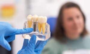 Close-up of a dentist's gloved hands holding a model of dental implants, showing the different components. A patient listens attentively in the background.